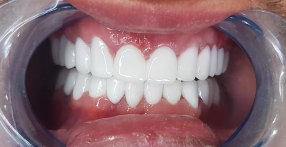 UK Smiles (Turkey Teeth, Veneers, Crowns, - UK's #1 Choice) - UK Smiles