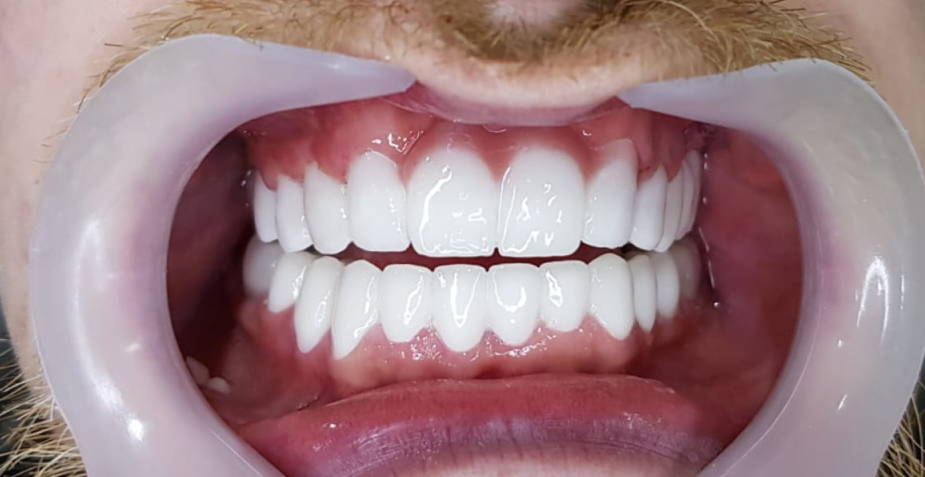 UK Smiles (Turkey Teeth, Veneers, Crowns, - UK's #1 Choice)