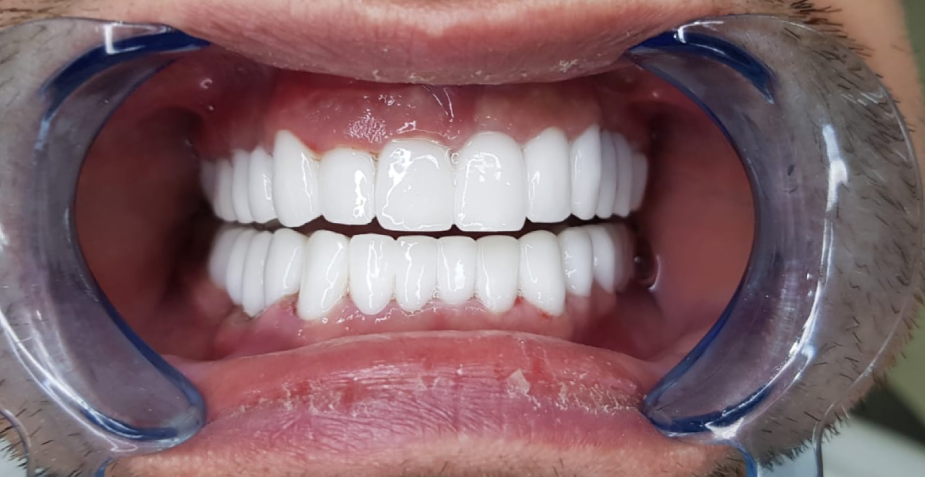 UK Smiles (Turkey Teeth, Veneers, Crowns, - UK's #1 Choice)