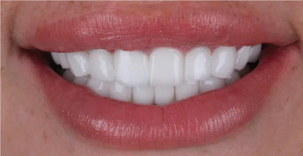 UK Smiles (Turkey Teeth, Veneers, Crowns, - UK's #1 Choice)