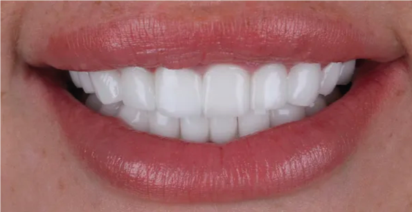 EMAX Laminate Veneers Turkey