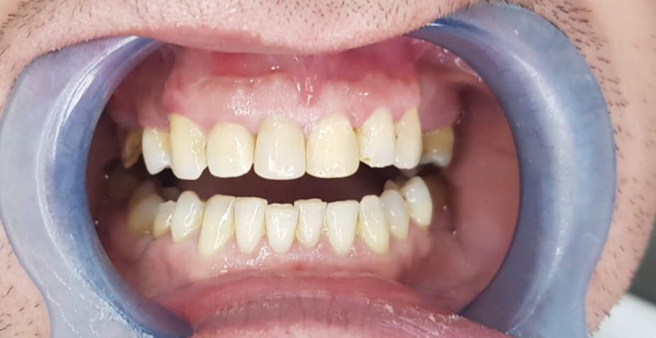 How Much Do Veneers From Turkey Cost? (Exact Prices 2023)