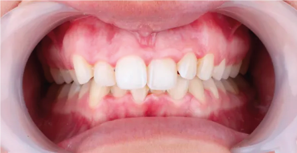 UK Smiles (Turkey Teeth, Veneers, Crowns, - UK's #1 Choice)